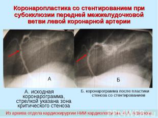 Коронаропластика со стентированием при субокклюзии передней межжелудочковой ветв