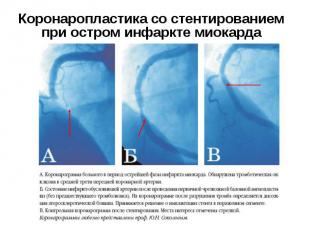 Коронаропластика со стентированием при остром инфаркте миокарда