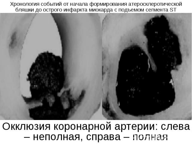 Окклюзия коронарной артерии: слева – неполная, справа – полная ПАТОГЕНЕЗ ИНФАРКТ МИОКАРДА С ЭЛЕВАЦИЕЙ СЕГМЕНТА ST связан с образованием тромбоцитарного тромба на поверхности лопнувшей или эрозированной атеросклеротической бляшки выраженность ишемии …