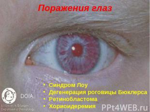 Поражения глаз Синдром Лоу Дегенерация роговицы Бюклерса Ретинобластома Хориоиде