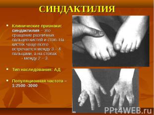 Клинические признаки: синдактилия – это сращение различных пальцев кистей и стоп