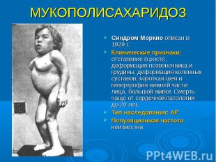 Синдром Моркио описан в 1929 г. Синдром Моркио описан в 1929 г. Клинические приз