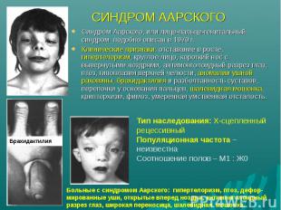 Синдром Аарского, или лице-пальце-генитальный синдром подобно описан в 1970 г. С