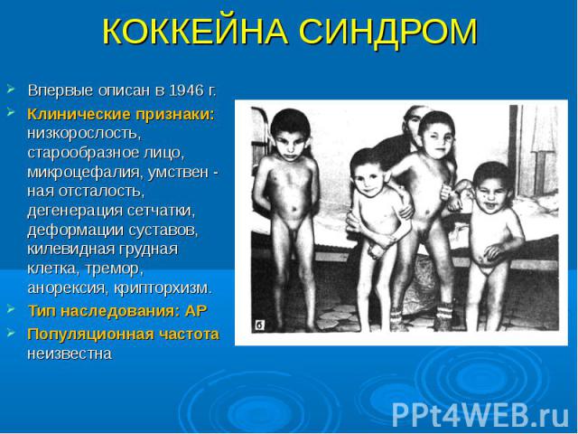 Впервые описан в 1946 г. Впервые описан в 1946 г. Клинические признаки: низкорослость, старообразное лицо, микроцефалия, умствен - ная отсталость, дегенерация сетчатки, деформации суставов, килевидная грудная клетка, тремор, анорексия, крипторхизм. …