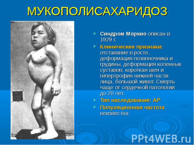 Синдром Моркио описан в 1929 г. Синдром Моркио описан в 1929 г. Клинические признаки: отставание в росте, деформация позвоночника и грудины, деформация коленных суставов, короткая шея и гипертрофия нижней части лица, большой живот. Смерть чаще от се…
