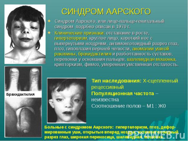 Синдром Аарского, или лице-пальце-генитальный синдром подобно описан в 1970 г. Синдром Аарского, или лице-пальце-генитальный синдром подобно описан в 1970 г. Клинические признаки: отставание в росте, гипертелоризм, круглое лицо, короткий нос с вывер…