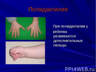 Полидактилия При полидактилии у ребенка развиваются дополнительные пальцы