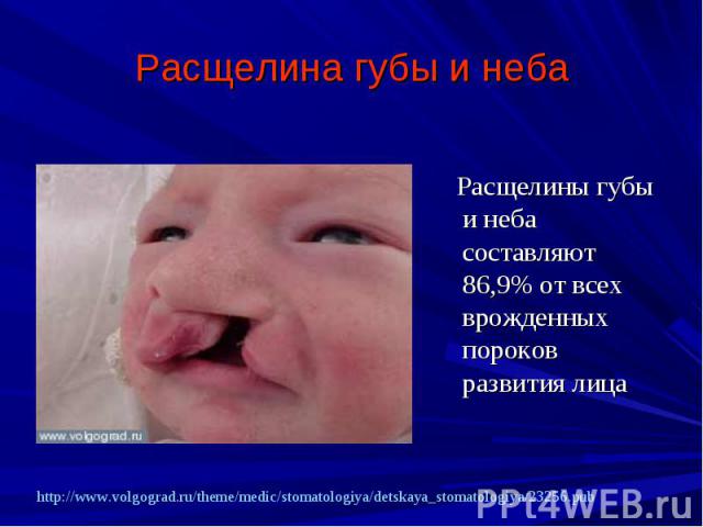 Расщелина губы и неба Расщелины губы и неба составляют 86,9% от всех врожденных пороков развития лица
