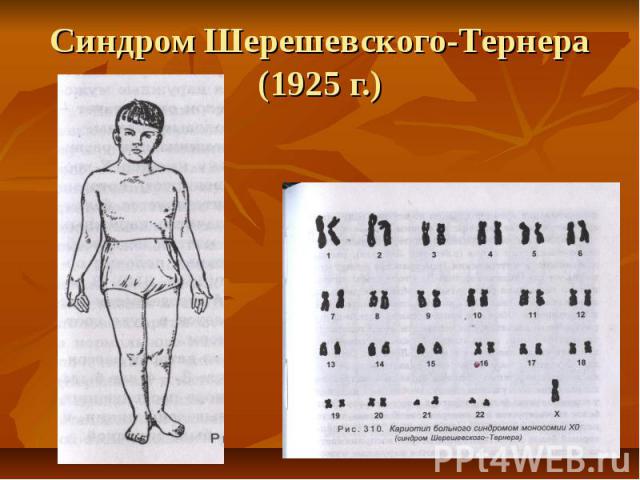 Синдром Шерешевского-Тернера (1925 г.)