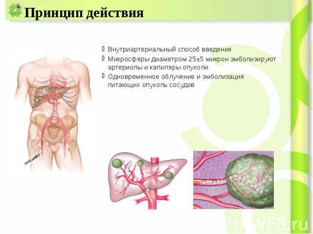 Принцип действия Внутриартериальный способ введения Микросферы диаметром 25±5 микрон эмболизируют артериолы и капиляры опухоли Одновременное облучение и эмболизация питающих опухоль сосудов