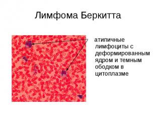 Лимфома Беркитта атипичные лимфоциты с деформированным ядром и темным ободком в
