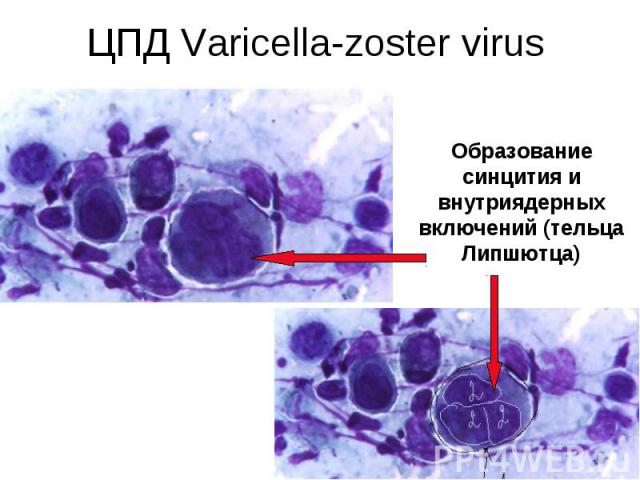 ЦПД Varicella-zoster virus