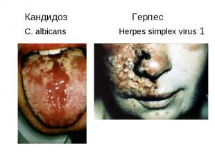 Кандидоз Герпес Кандидоз Герпес C. albicans Herpes simplex virus 1