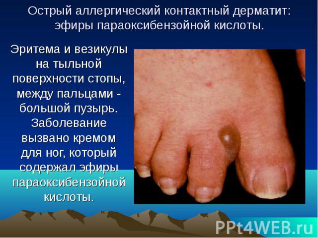 Острый аллергический контактный дерматит: эфиры параоксибензойной кислоты. Эритема и везикулы на тыльной поверхности стопы, между пальцами - большой пузырь. Заболевание вызвано кремом для ног, который содержал эфиры параоксибензойной кислоты.