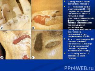 Электроожоги кожи различной степени: Электроожоги кожи различной степени: а&nbsp