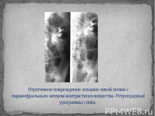 Ятрогенное повреждение лоханки левой почки с паранефральным затеком контрастного