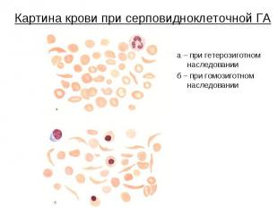Картина крови при серповидноклеточной ГА а – при гетерозиготном наследовании б –