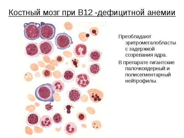 Костный мозг при В12 -дефицитной анемии Преобладают эритромегалобласты с задержкой созревания ядра. В препарате гигантские палочкоядерный и полисегментарный нейтрофилы.
