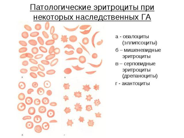 Патологические эритроциты при некоторых наследственных ГА а - овалоциты (эллипсоциты) б – мишеневидные эритроциты в – серповидные эритроциты (дрепаноциты) г - акантоциты