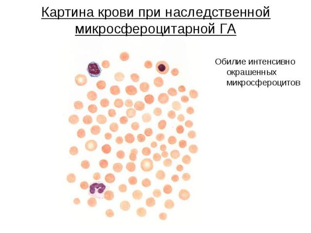 Картина крови при наследственной микросфероцитарной ГА Обилие интенсивно окрашенных микросфероцитов