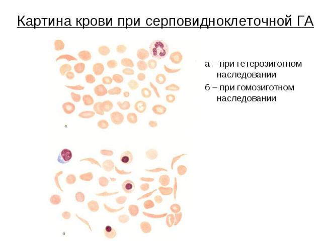 Картина крови при серповидноклеточной ГА а – при гетерозиготном наследовании б – при гомозиготном наследовании