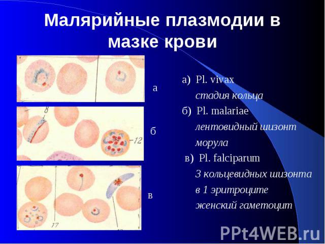 Малярийные плазмодии в мазке крови а) Pl. vivax стадия кольца б) Pl. malariae лентовидный шизонт морула в) Pl. falciparum 3 кольцевидных шизонта в 1 эритроците женский гаметоцит