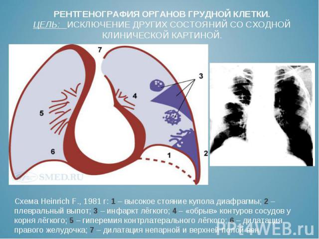 Схема Heinrich F., 1981 г: 1 – высокое стояние купола диафрагмы; 2 – плевральный выпот; 3 – инфаркт лёгкого; 4 – «обрыв» контуров сосудов у корня лёгкого; 5 – гиперемия контрлатерального лёгкого; 6 – дилатация правого желудочка; 7 – дилатация непарн…