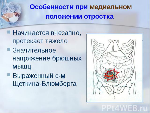 Особенности при медиальном положении отростка Начинается внезапно, протекает тяжело Значительное напряжение брюшных мышц Выраженный с-м Щеткина-Блюмберга