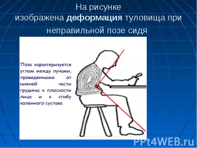 На рисунке изображена деформация туловища при неправильной позе сидя