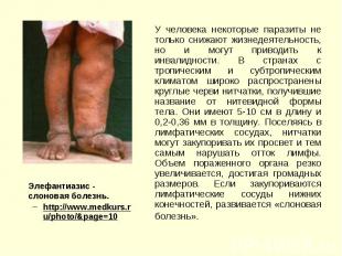 Элефантиазис - cлоновая болезнь. Элефантиазис - cлоновая болезнь. http://www.med
