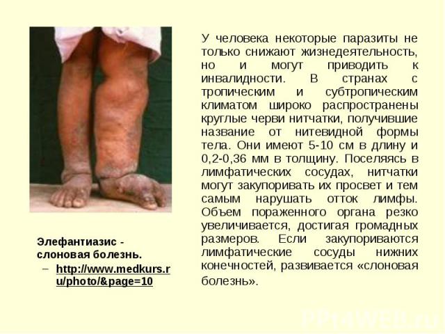 Элефантиазис - cлоновая болезнь. Элефантиазис - cлоновая болезнь. http://www.medkurs.ru/photo/&page=10