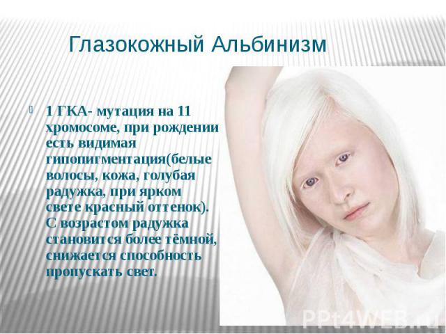 Глазокожный Альбинизм 1 ГКА- мутация на 11 хромосоме, при рождении есть видимая гипопигментация(белые волосы, кожа, голубая радужка, при ярком свете красный оттенок). С возрастом радужка становится более тёмной, снижается способность пропускать свет.