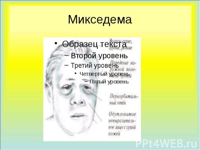Микседема что за болезнь. Претибиальная микседема тиреотоксикоз. Микседема щитовидной железы.