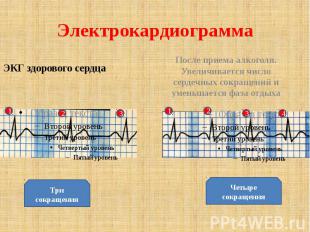 Электрокардиограмма ЭКГ здорового сердца