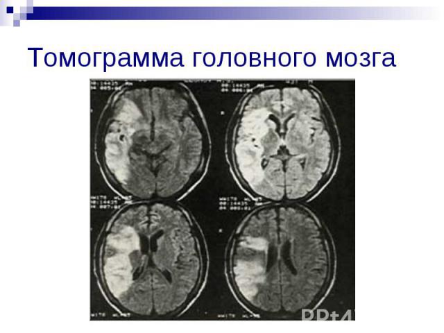 Томограмма головного мозга