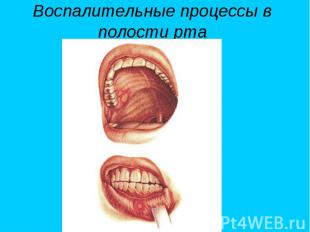 Воспалительные процессы в полости рта