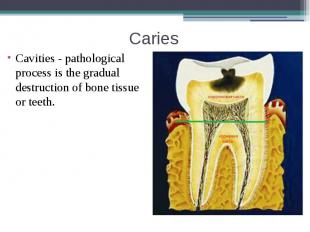 Caries Cavities - pathological process is the gradual destruction of bone tissue