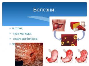 Болезни: гастрит; язва желудка; спаечная болезнь; Заболевания печени.