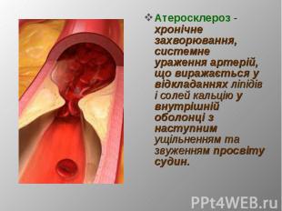 Атеросклероз - хронічне захворювання, системне ураження артерій, що виражається