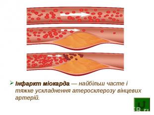 Інфаркт міокарда — найбільш часте і тяжке ускладнення атеросклерозу вінцевих арт