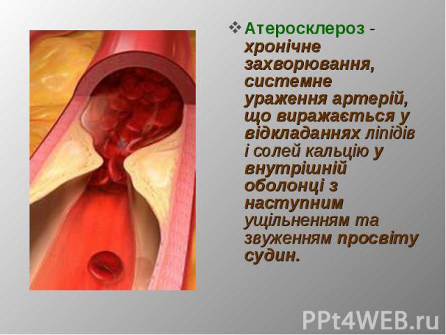 Атеросклероз - хронічне захворювання, системне ураження артерій, що виражається у відкладаннях ліпідів і солей кальцію у внутрішній оболонці з наступним ущільненням та звуженням просвіту судин. Атеросклероз - хронічне захворювання, системне ураження…