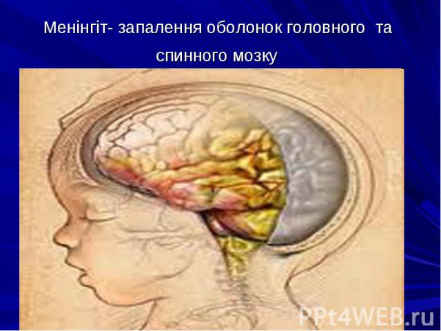 Менінгіт- запалення оболонок головного та спинного мозку