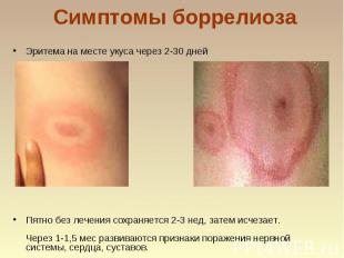 Симптомы боррелиоза Эритема на месте укуса через 2-30 дней Пятно без лечения сох