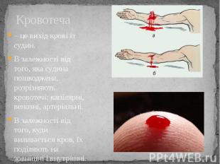 Кровотеча – це вихід крові із судин. В залежності від того, яка судина пошкоджен