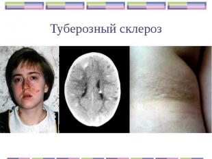 Туберозный склероз Аутосомно-доминантное заболевание с выраженной пенетрантность