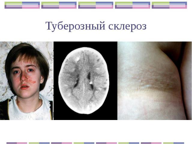 Туберозный склероз Аутосомно-доминантное заболевание с выраженной пенетрантностью и высоким уровнем спонтанных мутаций Генетическое заболевание, характеризующееся поражением нервной системы, кожи, внутренних органов, органов зрения, костной и нейроэ…