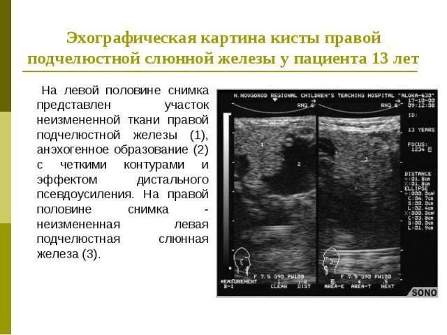 На левой половине снимка представлен участок неизмененной ткани правой подчелюстной железы (1), анэхогенное образование (2) с четкими контурами и эффектом дистального псевдоусиления. На правой половине снимка - неизмененная левая подчелюстная слюнна…