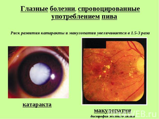 Глазные болезни, спровоцированные употреблением пива Глазные болезни, спровоцированные употреблением пива Риск развития катаракты и макулопатии увеличивается в 1.5-3 раза