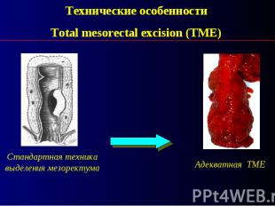 Технические особенности Total mesorectal excision (TME)