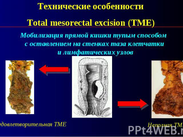 Технические особенности Total mesorectal excision (TME